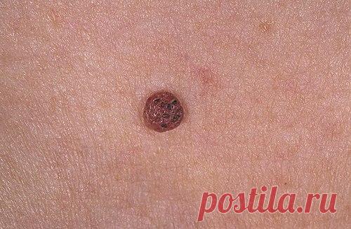 Как удалить кондиломы, темные пятна, угри и папиллому быстро и эффективно