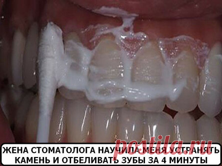 Жена стоматолога научила меня устранять зубной камень и отбеливать зубы за 4 минуты