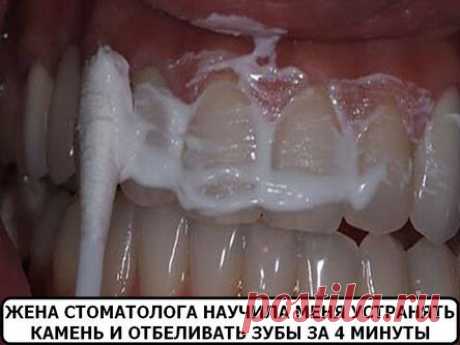 Жена стоматолога научила меня устранять зубной камень и отбеливать зубы за 4 минуты