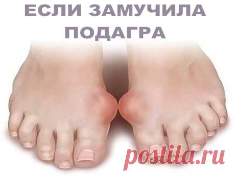 ЕСЛИ ЗАМУЧИЛА ПОДАГРА | Полезные советы!