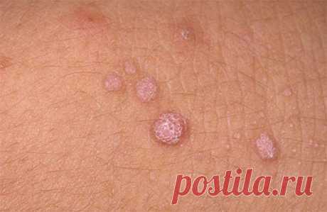 БОРОДАВКИ,КОНДИЛОМЫ,ПАПИЛЛОМЫ...??? ЛЕЧИМ