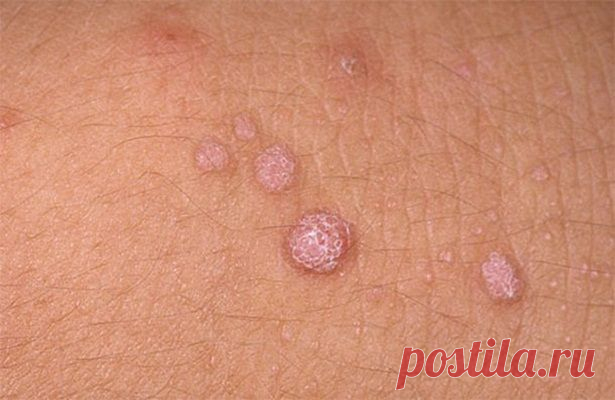 БОРОДАВКИ,КОНДИЛОМЫ,ПАПИЛЛОМЫ...??? ЛЕЧИМ