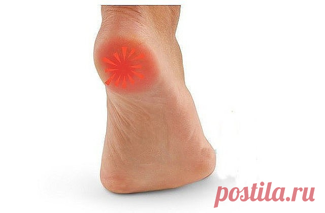 ШПОРУ ВЫЛЕЧИЛА ЗА 3 ДНЯ
Поделюсь рецептами от пяточных шпор. Прошлым летом на юге после ванн у меня так разболелась нога, что я не знала, куда ее деть. Пятка горела огнем. Приехав домой, побежала к хирургу. Молодая врач сделала снимок и объявила, что у меня после ванн обострилась пяточная шпора. Дала мне какую-то «памятку» - и все. Я поняла, что надо самой лечиться. Обратилась к народной медицине - стала искать рецепты от шпор. Все, что нашла, выписала и посылаю вам. Ведь ...