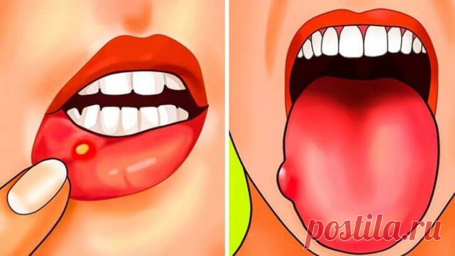 Дефицит фолиевой кислоты. 5 причин и 12 симптомов! Вы часто чувствуете усталость или страдаете от язвенной болезни? Вы, вероятно, страдаете от дефицита фолиевой кислоты… Фолиевая кислота: витамин B9 является водорастворимым витамином, то есть не храниться в организме. В результате есть постоянная потребность в источниках питания, богатых этим веществом.