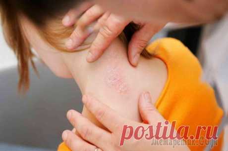 Псориаз: причины возникновения и симптомы, лечение болезни Кожа – орган, защищающий нас от проникновения в организм чужеродных веществ и возбудителей болезней. 
К сожалению, кожа также подвержена различным заболеваниям, и псориаз относится к числу наиболее тр...