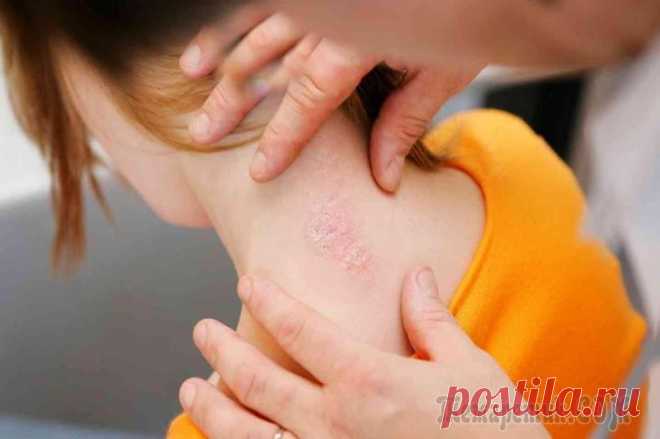 Псориаз: причины возникновения и симптомы, лечение болезни Кожа – орган, защищающий нас от проникновения в организм чужеродных веществ и возбудителей болезней. 
К сожалению, кожа также подвержена различным заболеваниям, и псориаз относится к числу наиболее тр...