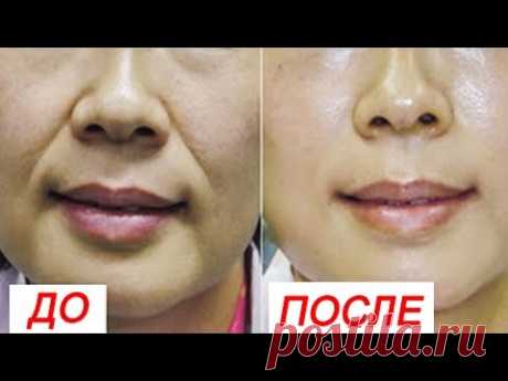 Как убрать носогубные складки? Натурально, через 1 месяц. 100%