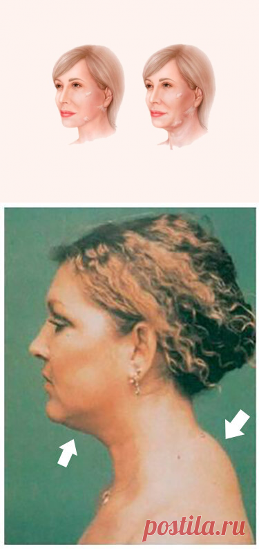 Как связаны холка и поплывший овал лица

Бывает, глядишь на женщину, вроде и лицо в порядке, и в общем ухожена, но что-то не так. Она все равно кажется возрастной.

Все дело в том, как она выглядит в профиль. Точнее то, как выглядит в профиль ее шея. ➡️ Читайте, кликнув на фото