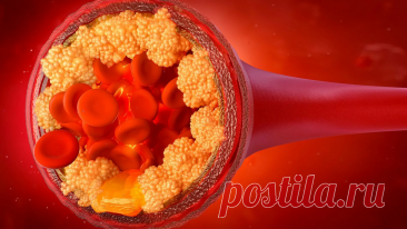 Можно ли растворить бляшки? | Кардиолог Константин Крулёв | Дзен