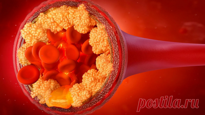 Можно ли растворить бляшки? | Кардиолог Константин Крулёв | Дзен