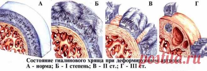 Заострение межмыщелковых возвышений коленного сустава: лечение