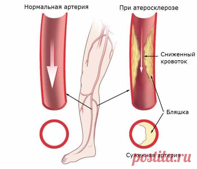 Атеросклероз артерий нижних конечностей - лечение и симптомы
