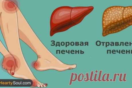 15 признаков поражения печени, о которых нужно знать Печень помогает нашему организму переваривать пищу, поглощать питательные и устранять токсичные вещества. Этот орган жизненно важен для человека.

Проблемы с печенью могут быть наследственными, вызванными токсинами (химическими веществами или вирусами) или быть последствием тяжелого заболевания (н