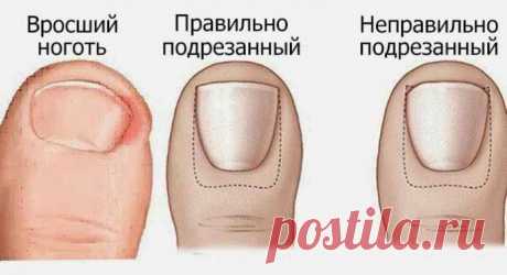 Лучшие домашние средства для лечения вросших ногтей 


Стоит попробовать!







 


Вросшие ногти на ногах случаются, когда кромка ногтя выгибается и впивается в кожу. Вросшие ногти на ногах часто вызывают дискомфорт, такой как боль, отек и покраснени…