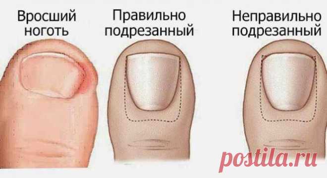 Лучшие домашние средства для лечения вросших ногтей 


Стоит попробовать!







 


Вросшие ногти на ногах случаются, когда кромка ногтя выгибается и впивается в кожу. Вросшие ногти на ногах часто вызывают дискомфорт, такой как боль, отек и покраснени…