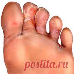 Народные средства от грибка на пальцах ног