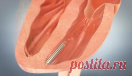 Кардиостимулятор сердца: стоимость операции, отзывы