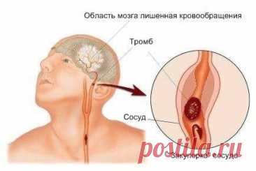 ИНСУЛЬТ: Запомните всего 3 первых шага, чтобы спасти себе и близким жизнь!