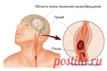 ИНСУЛЬТ: Запомните всего 3 первых шага, чтобы спасти себе и близким жизнь!