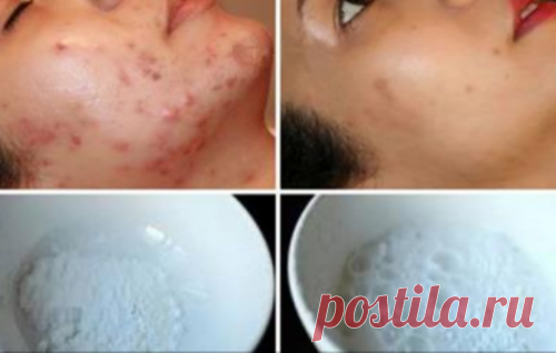 Эта маска магически удаляет пятна, шрамы, угревую сыпь и морщины!