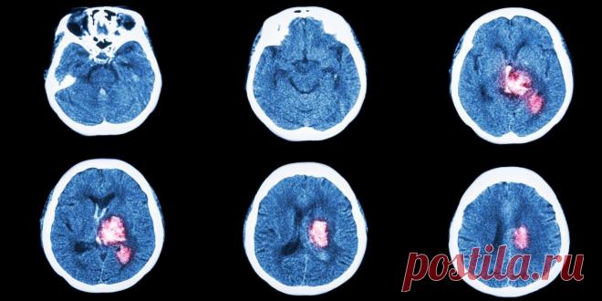 6 признаков инсульта, при которых нужно действовать как можно быстрее 

У врачей есть несколько часов, чтобы спасти человека. Симптомы инсульта нужно знать всем, чтобы успеть распознать болезнь.


Инсульт — это нарушение кровообращения мозга. Когда кровь не поступает к …