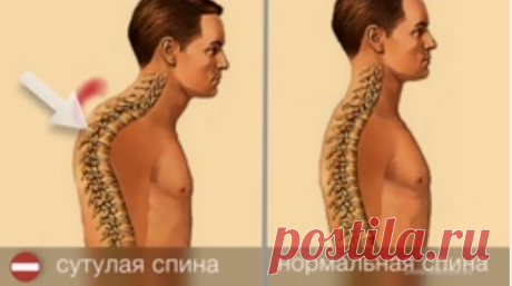 Комплекс упражнений для исправления сутулости - Упражнения и похудение Как ни странно, но для поддержания нормальной осанки, мышцы спины работают намного меньше, чем для удержания сутулой спины. Слишком большое округление позвоночника в грудном отделе (кифоз) в простой речи называют сутулостью. Чтобы перестать сутулиться, нужно держать спину в выпрямленном положении. А это возможно за счет создания мышечного корсета, а именно в области грудного отдела позвоночника. …