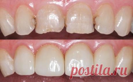 7 советов для прямой реставрации фронтальной группы зубов О чем данная статья? Не каждый стоматолог обладает талантами, присущими настоящим мастерам реставрации. В действительности, это относится к подавляющему большинству моих коллег. Более того, не каждая прямая реставрация передних зубов требует нанесения материала в три слоя, непрозрачности, подбора полутонов. Большинство стоматологов, кто ежедневно выполняет реставрации передних зубов, имеют отлаженную схему работы, п...