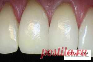 Наращивание зубов без пломбирования