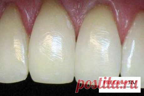 Наращивание зубов без пломбирования