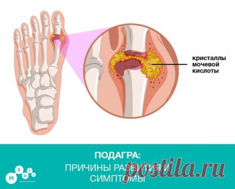 Подагра – системное заболевание, характеризующееся отложением в различных тканях кристаллов мочевой кислоты и развивающимся в связи с этим воспалением.

Мочевая кислота – продукт обмена пуриновых оснований, которые входят в состав ДНК. Поскольку развитие подагры связано с повышением уровня мочевой кислоты в крови, необходимо знать, какие продукты приводят к этому:
•Мясо (включая мясные субпродукты – почки, мозги, печень) •Рыба
•Большое количество соевого белка
•Напитки, со...