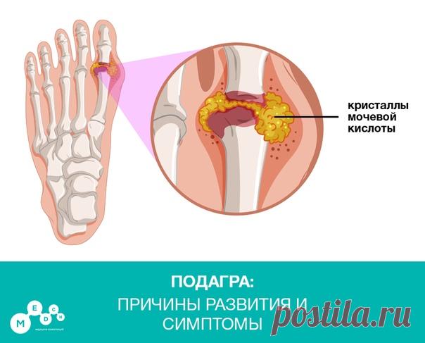 Подагра – системное заболевание, характеризующееся отложением в различных тканях кристаллов мочевой кислоты и развивающимся в связи с этим воспалением.

Мочевая кислота – продукт обмена пуриновых оснований, которые входят в состав ДНК. Поскольку развитие подагры связано с повышением уровня мочевой кислоты в крови, необходимо знать, какие продукты приводят к этому:
•Мясо (включая мясные субпродукты – почки, мозги, печень) •Рыба
•Большое количество соевого белка
•Напитки, со...
