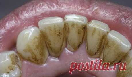10 простых способов легко удалить зубной камень без визита к зубному врачу!
Для предотвращения образования зубного камня необходимо регулярно проводить профилактику его образования натуральными способами. Если зубной камень уже образовался, то предлагаем вам 10 простых способов легко удалить его без посещения стоматолога. Неправильная чистка может привести к образованию зубного налета и тогда...
Читай дальше на сайте. Жми подробнее ➡