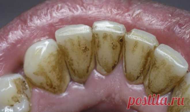 10 простых способов легко удалить зубной камень без визита к зубному врачу!
Для предотвращения образования зубного камня необходимо регулярно проводить профилактику его образования натуральными способами. Если зубной камень уже образовался, то предлагаем вам 10 простых способов легко удалить его без посещения стоматолога. Неправильная чистка может привести к образованию зубного налета и тогда...
Читай дальше на сайте. Жми подробнее ➡