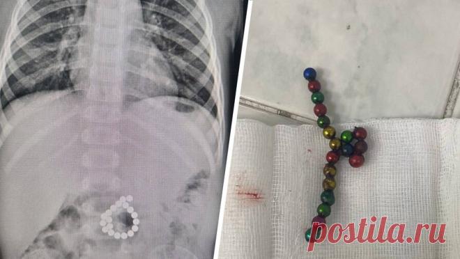 В ХМАО двухлетний мальчик наглотался магнитов. В Сургуте врачи спасли двухлетнего ребенка, который наглотался деталей магнитного конструктора, мальчик почти неделю провел в реанимации. Об этом в Telegram-канале сообщил глава депздрава ХМАО Роман Паськов. Ребенок был доставлен в ...