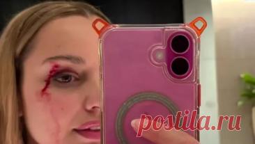 Птица атаковала журналистку и рассекла ей лицо во время съемок репортажа. Птица ударила девушку-репортера по лицу во время уличной съемки в Новой Зеландии. Об этом пишет газета Metro. Джесс Тайсон, бывшая Мисс Новая Зеландия и репортер телеканала Māori TV, была атакована птицей, когда снимала сюжет для ...