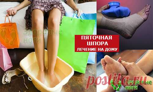Топ-10 методов лечения пяточной шпоры в домашних условиях. Проверенные рецепты, как вылечить пяточную шпору на дому