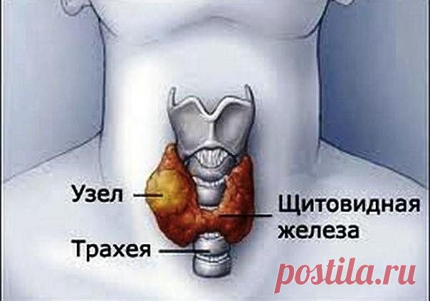 ЛЕЧИМ УЗЕЛ НА ЩИТОВИДНОЙ ЖЕЛЕЗЕ

Смешайте по одному стакану молотой гречневой крупы, пропущенных через мясорубку грецких орехов и меда в эмалированной (абсолютно чистой) посуде и переложите в стеклянную банку. Один раз в неделю за целый день съешьте этот состав, не принимая больше никакой пищи, кроме воды. Сделайте так шесть раз, т. е. шесть недель. Затем через месяц повторите лечение. Уже после первого курса зоб уменьшится, а после второго болезнь оставит вас. Проверьтесь...
