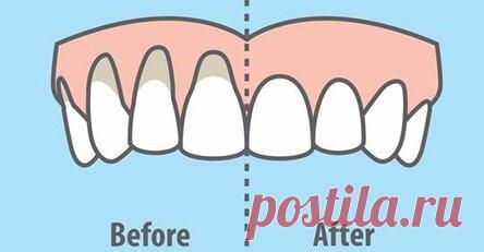 10 легких способов исцеления оголенных десен естественным способом Результат не заставит себя ждать! Рецессия десен возникает, когда край ткани десны, которая окружает зуб, отступает назад, обнажая корень зуба. Если пренебречь проблемой, ткань зубов может значительно повредиться, что в конечном итоге приведет к потере зубов. Почему десны оголяются?  Существуют различные факторы, которые способствуют рецессии десен, из которых наиболее распространены следующие: 1. Генетичес...