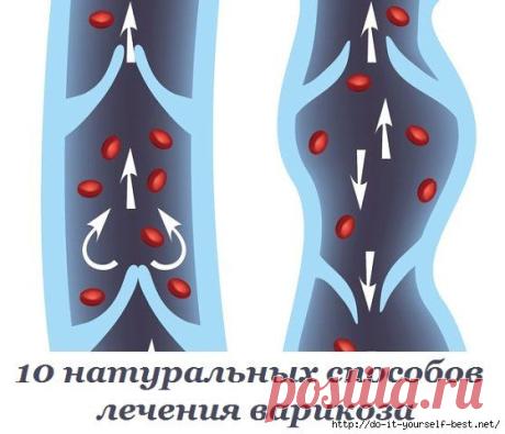10 натуральных способов лечения варикоза