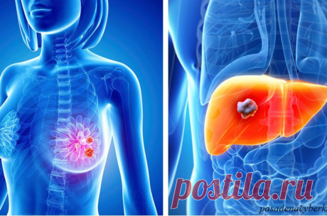 Вот те симптомы рака, которые появляются за 2-5 лет до самой болезни Ранняя диагностика онкологических заболеваний повышает шансы на успешное лечение, пишет Bestie. Однако на начальных этапах рак может никак себя не проявлять. Человек чувствует себя здоровым и даже бодрым. Как же определить, что он развивается и вскоре может перерасти в серьезную проблему? Вот несколько самых распространенных видов рака и их ранние признаки: 1. Рак легких и […]