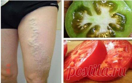 Как вылечить варикозное расширение вен с помощью зеленых и красных помидоров!