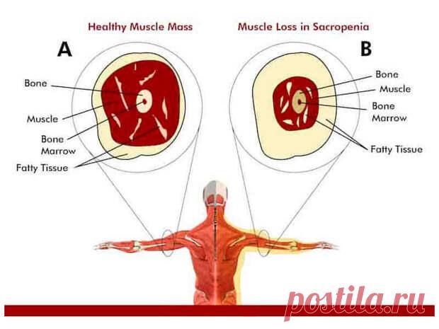 Что нужно знать о саркопении
Саркопенией называют возрастную атрофическую дегенеративную потерю мышечной массы и силы. В основном, эта патология развивается у людей после пятидесятилетия. Примерно у одного из десяти человек после 50 лет, возникают симптомы мышечной дегенерации. Это во многом объясняет падения и переломы у людей пожилого возраста.          Мышечная дегенерация после 50 лет После 25-30-летия начинают замедляться процессы регенерации и […]
Читай дальше на сайте. Жми подробнее ➡
