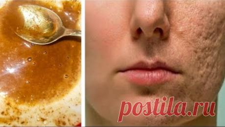 Любой ШРАМ, Морщины или ПЯТНА у Вас на ЛИЦЕ. ИСЧЕЗНУТ за Считанные МИНУТЫ! Даже Врачи в ШОКЕ!