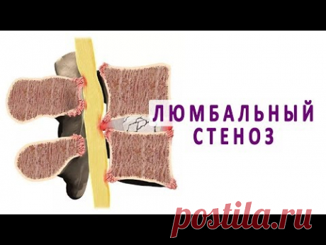 Что такое люмбальный стеноз и как он лечится?