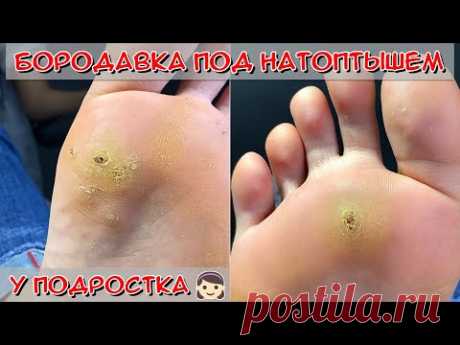 Бородавка на стопе у подростка / Натоптыши на ступнях