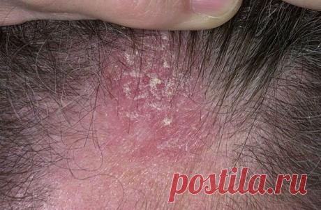 Себорейный дерматит: волосистой части головы, лица, лечение, типы, симптомы, дополнительная терапия при дерматите