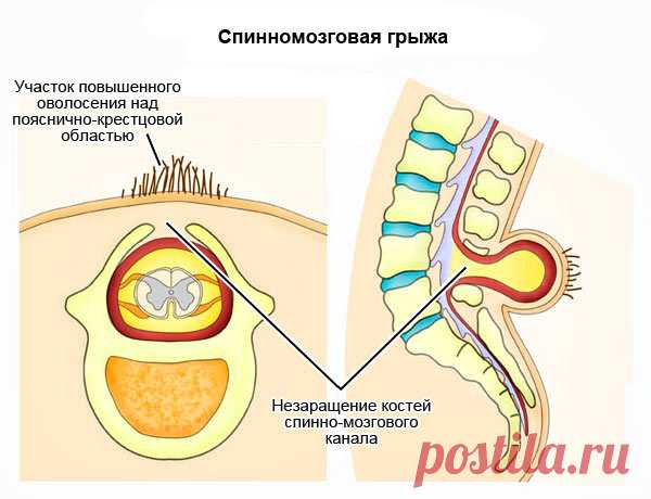 Спинномозговая грыжа: классификация, причины, лечение
В организме человека могут развиваться разные заболевания, одно из них – спинномозговая грыжа. Формируется во время беременности. Чаще всего проявляется в поясничном отделе, реже в других местах. Патология представляет собой, несрастание нескольких позвонков, с выпадением спинного мозга и нервных окончаний.