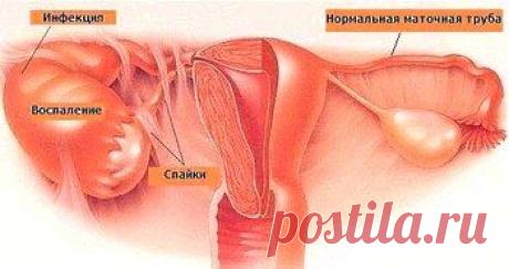 Аднексит – симптомы, лечение, причины, диагностика и профилактика.