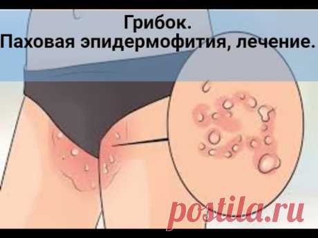 Грибок. Паховая эпидермофития, лечение.