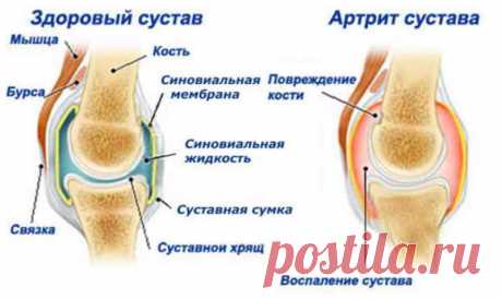 Как я тяжелый артроз вылечила картошкой Артрит — это собирательное обозначение любых поражений суставов. Может быть основным заболеванием или проявлением другой болезни. Протекает в острой и